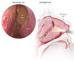 Enlarged deals nasal polyps