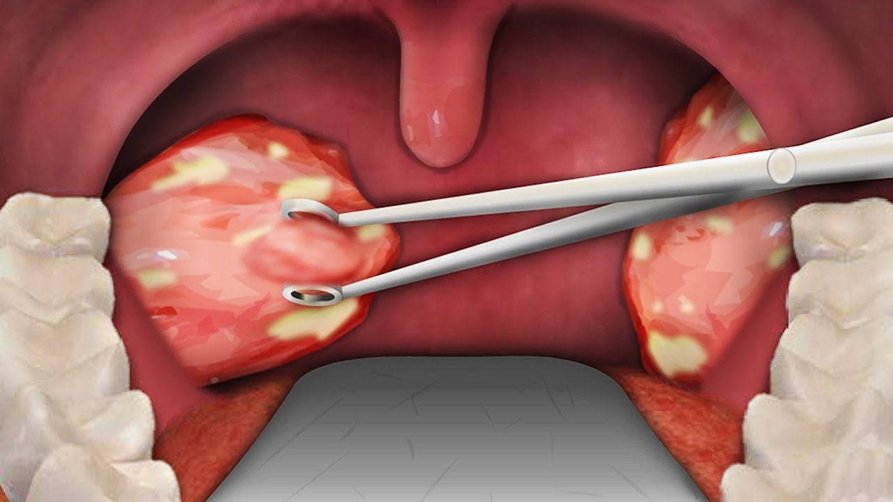 tonsillectomy procedure step by step